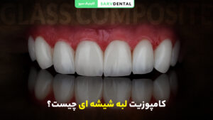 معرفی کامپوزیت شیشه‌ای دندان و کاربردها