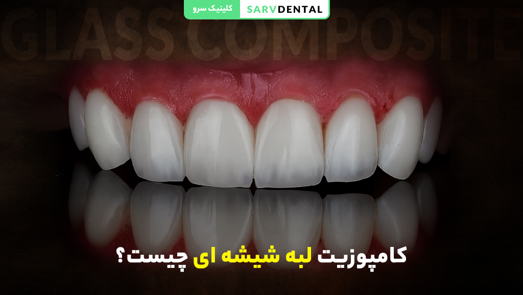 معرفی کامپوزیت شیشه‌ای دندان و کاربردها