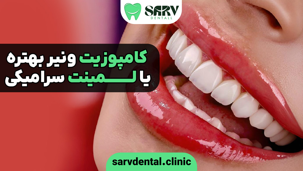 کامپوزیت ونیر بهتره یا لمینت سرامیکی