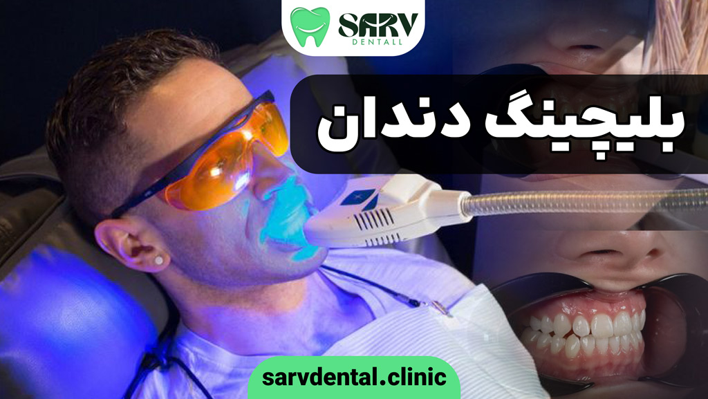 بلیچینگ دندان