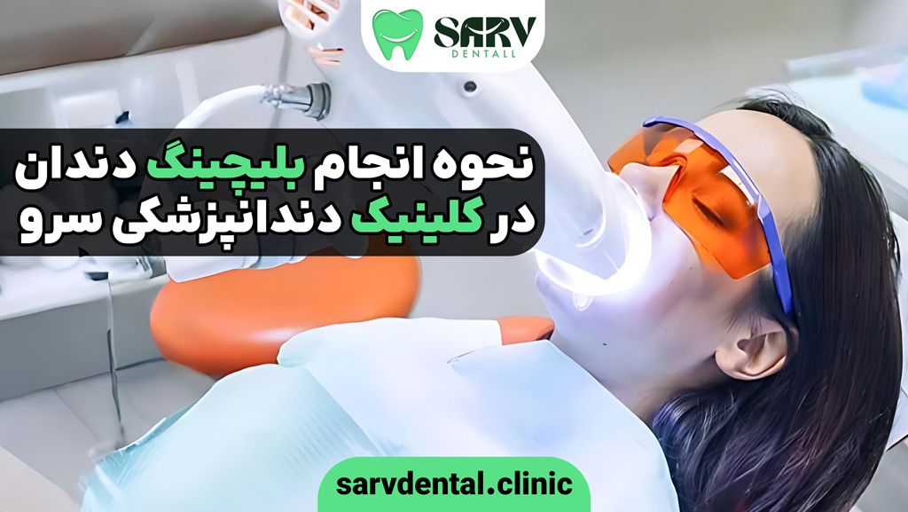 نحوه انجام بلیچینگ دندان