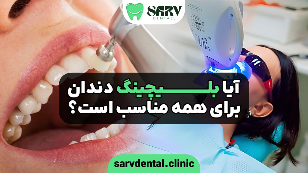 بلیچینگ دندان برای چه کسانی مناسب است؟