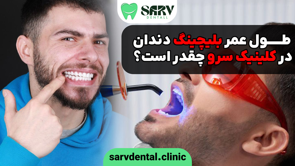 طول عمر بلیچینگ دندان در کلینیک سرو چقدر است؟