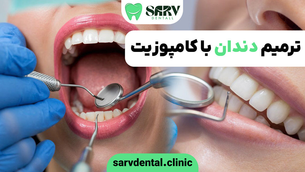  ترمیم دندان با کامپوزیت
