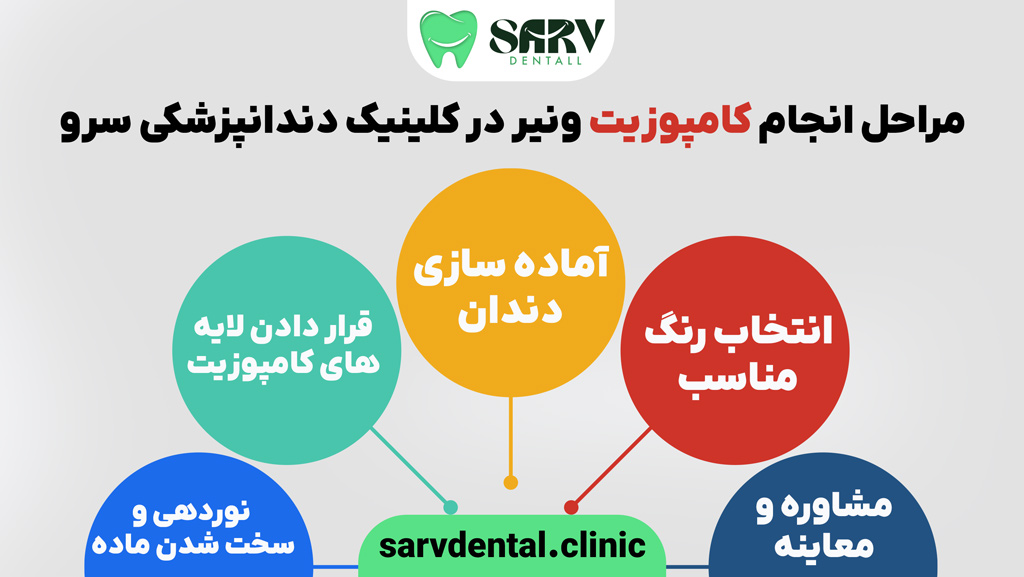 مراحل انجام کامپوزیت ونیر در کلینیک دندانپزشکی سرو