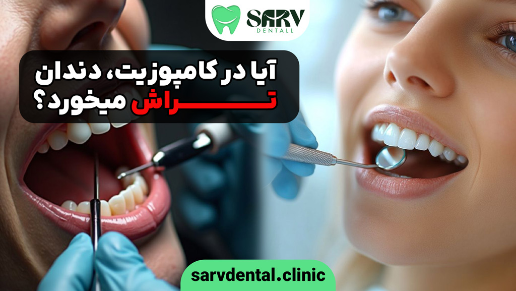 آیا در کامپوزیت، دندان تراش می خورد؟