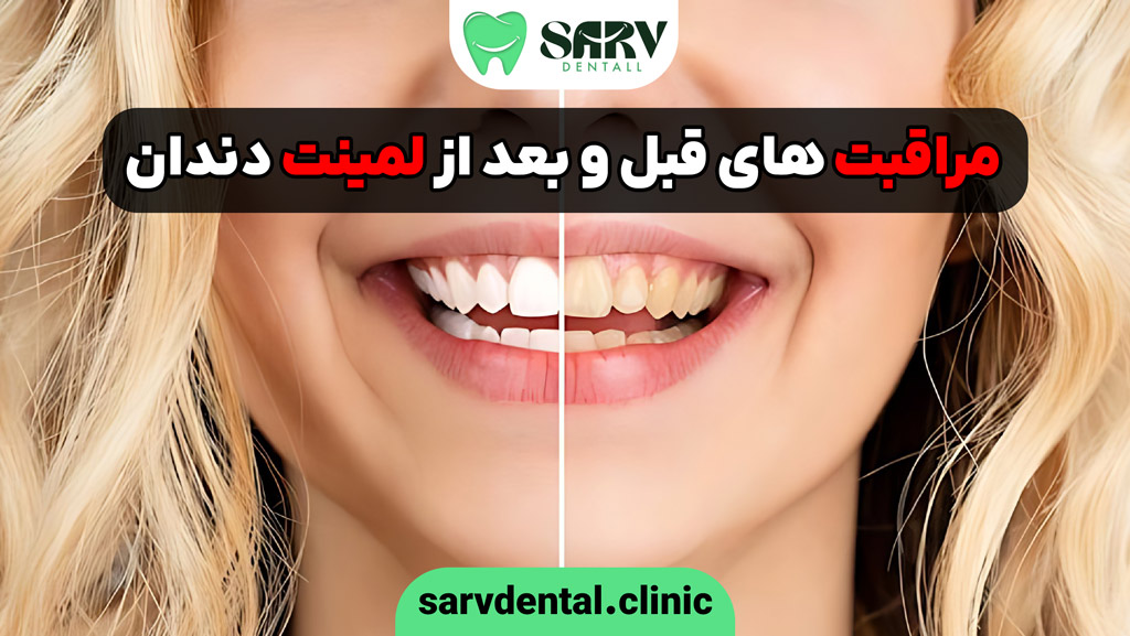 مراقبت های قبل و بعد از لمینت دندان