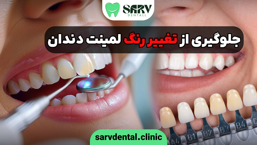 جلوگیری از تغییر رنگ لمینت دندان