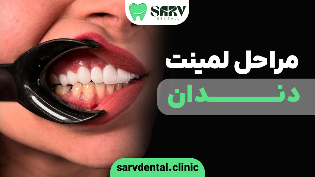 مراحل لمینت دندان چیست؟