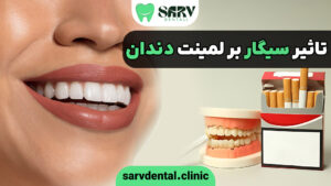 تاثیر سیگار بر لمینت دندان