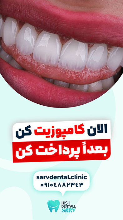 کامپوزیت دندان قسطی