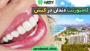 کامپوزیت دندان در کیش