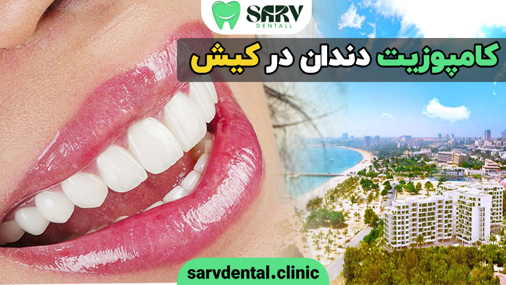 کامپوزیت دندان در کیش