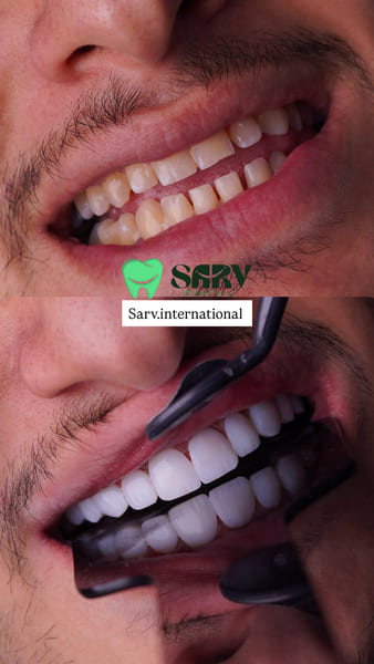 رایج‌ترین اشتباهات هنگام انتخاب کامپوزیت آلمانی