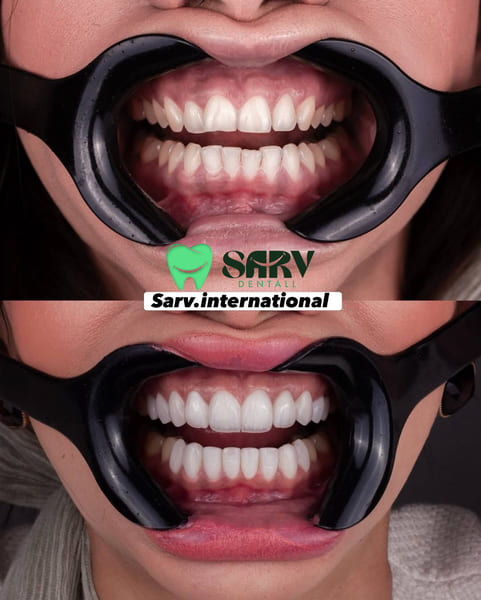 بعد از کامپوزیت چه چیزهایی نباید بخوریم؟