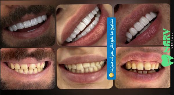 مقایسه کامپوزیت IPS با سایر مارکها