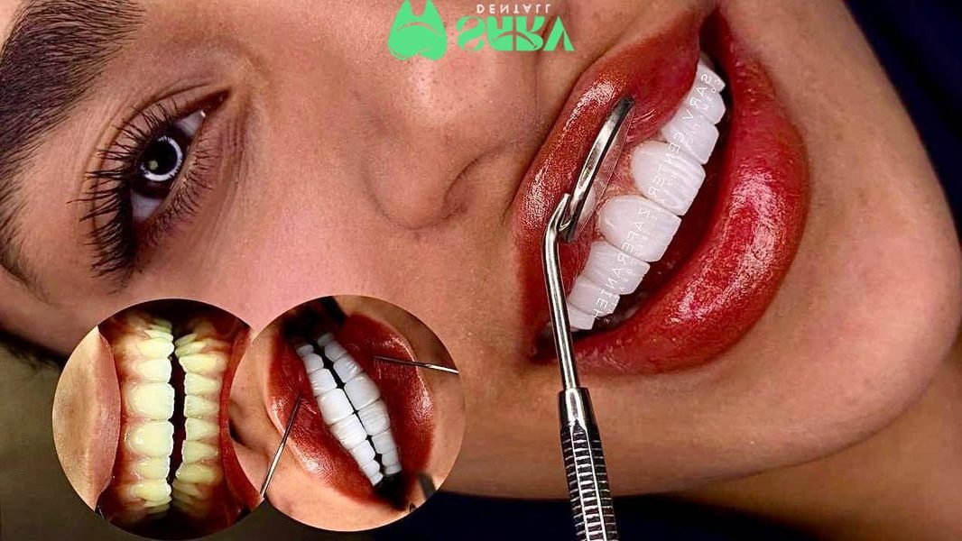 بعد از کامپوزیت تا چند ساعت نباید چیزی خورد؟