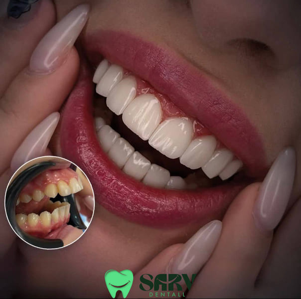 مراقبت های لازم برای افزایش طول عمر کامپوزیت آی پی اس