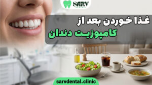 غذا خوردن بعد از کامپوزیت دندان