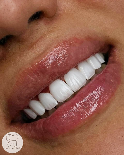 ویژگیهای کامپوزیت سوئیسی