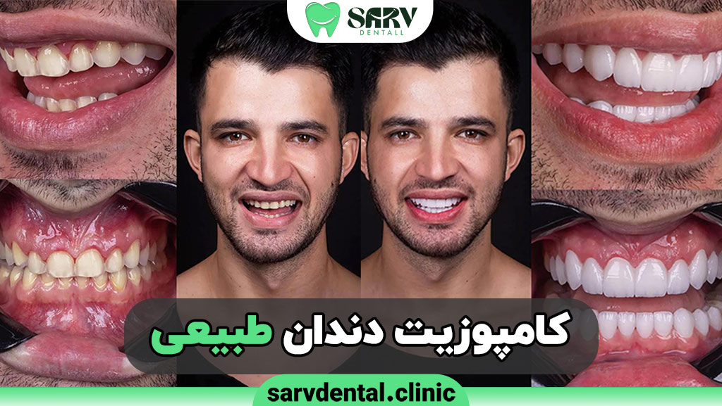 کامپوزیت دندان طبیعی