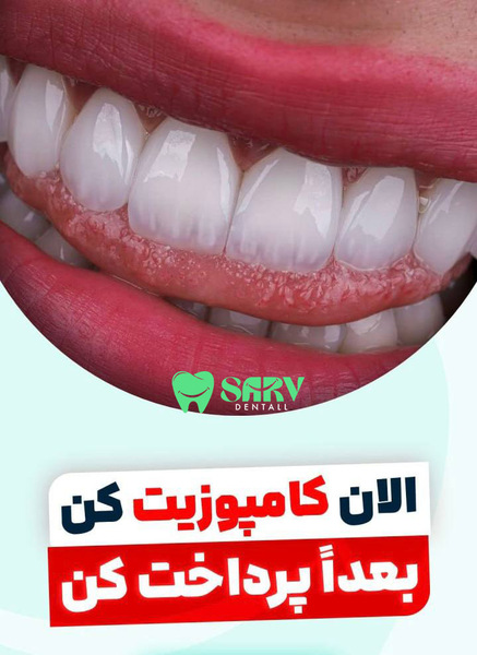 پرداخت اقساطی کامپوزیت سفید یخی