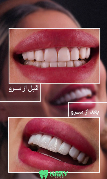 کامپوزیت توکویاما در کلینیک سرو