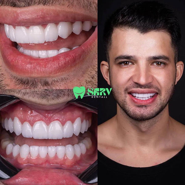 نمونه کار کامپوزیت کاریزما