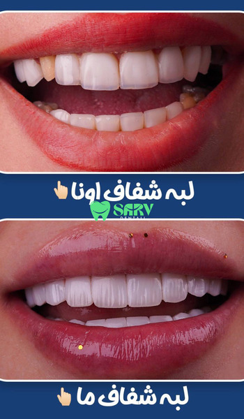 قبل و بعد کامپوزیت توکویاما
