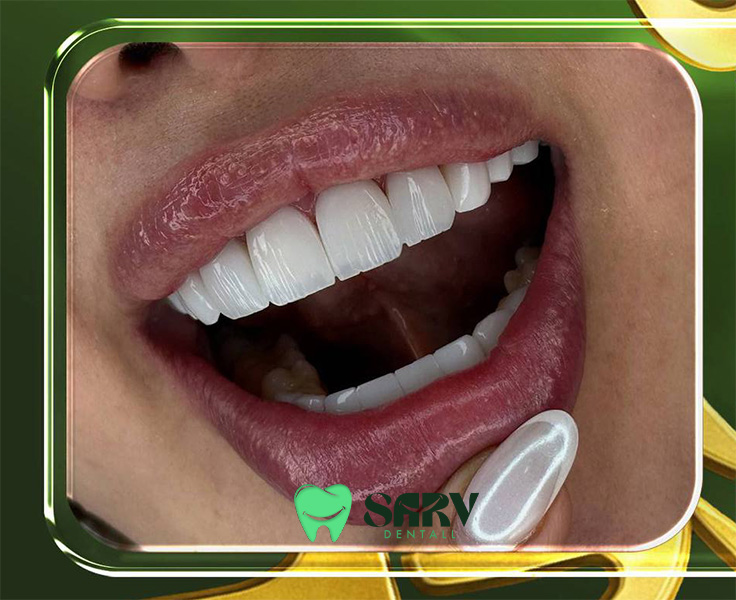 مزایای کامپوزیت آی پی اس