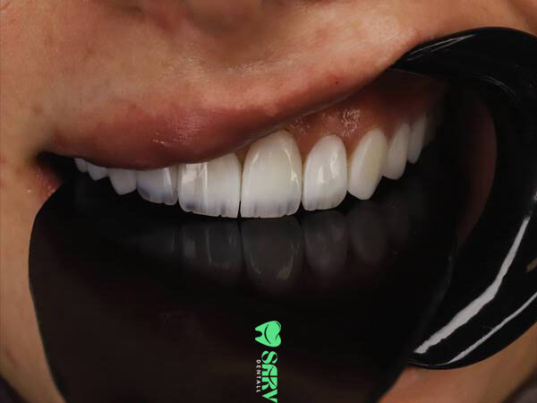 کامپوزیت کاریزما در کلینیک سرو