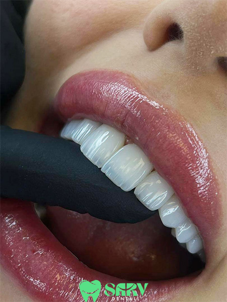 sarv dental composit