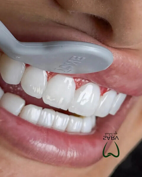 نمونه کار کامپوزیت کلینیک سرو