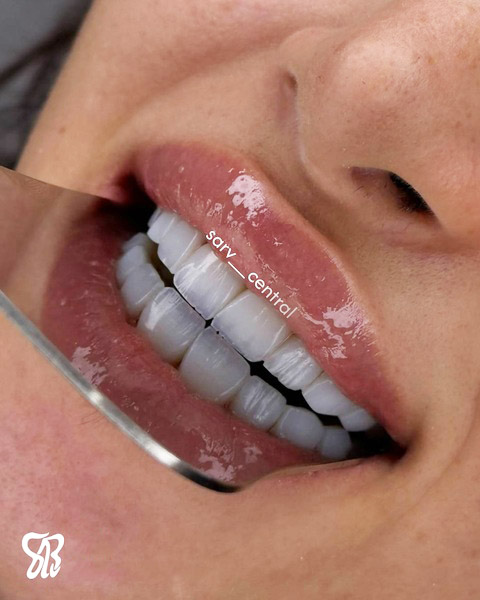 چگونه بعد از کامپوزیت قهوه بخوریم که باعث تغییر رنگ نشود؟