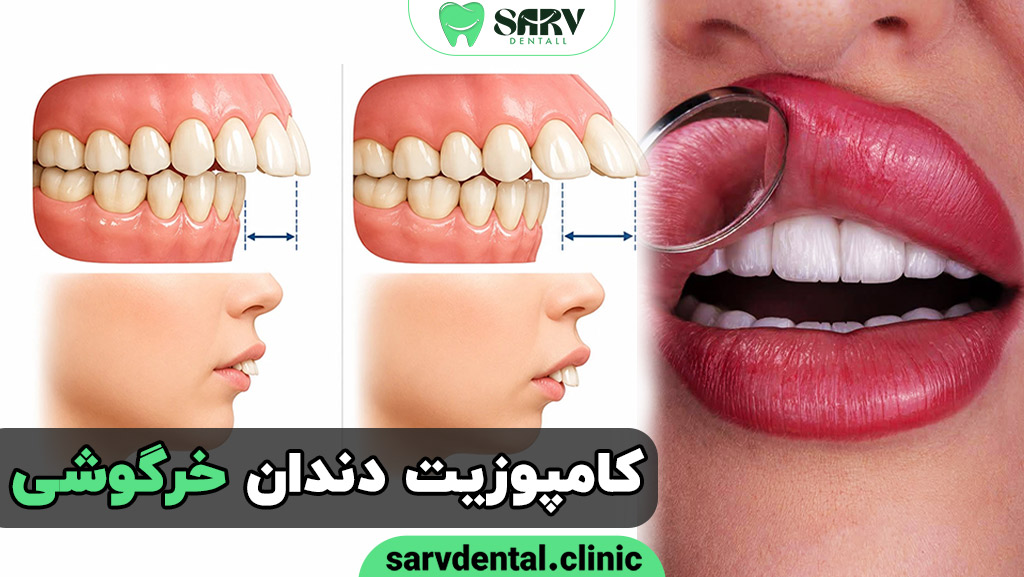 کامپوزیت دندان برای دندان خرگوشی